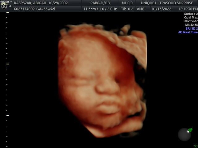 surprise baby ultrasound
